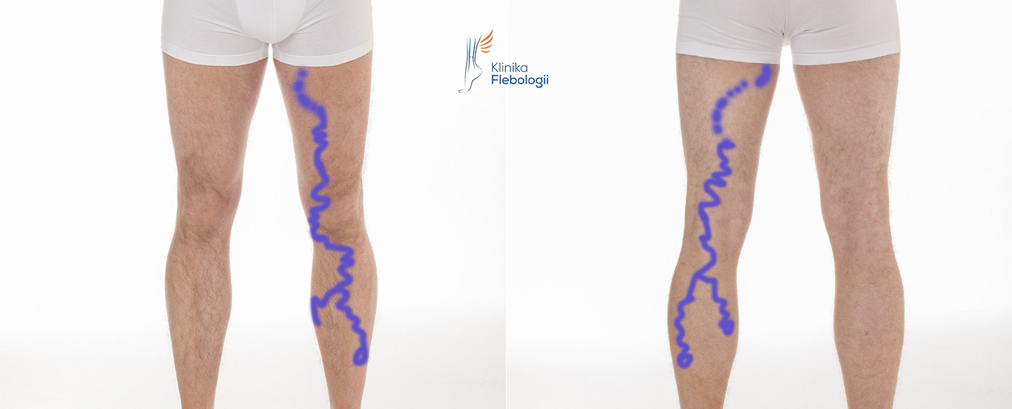 ŻYLAKI ATYPOWE KOŃCZYN DOLNYCH W PRZEBIEGU NIEWYDOLNOŚCI LEWEJ ŻYŁY JĄDROWEJ