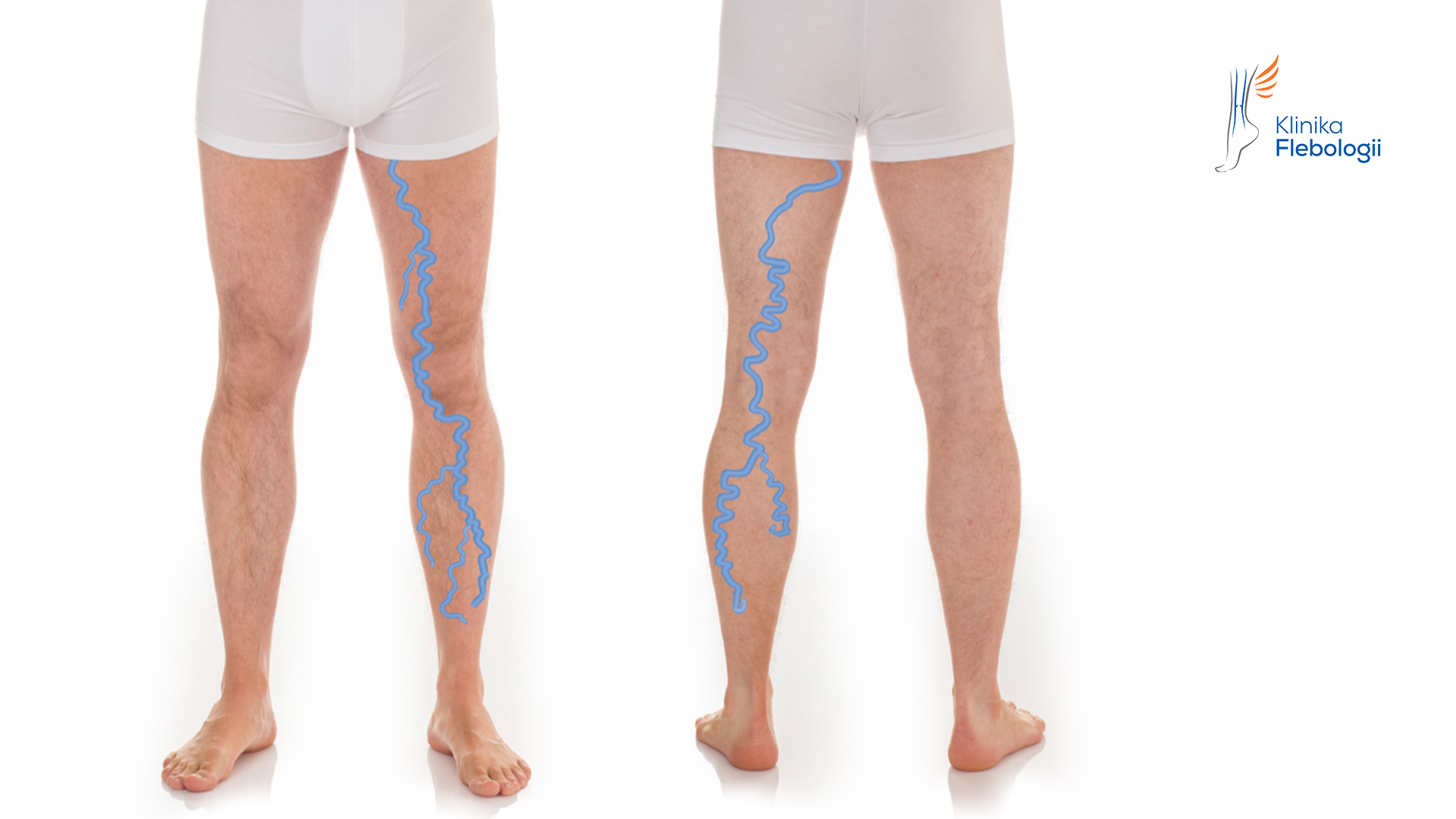 ŻYLAKI ATYPOWE KOŃCZYN DOLNYCH W PRZEBIEGU NIEWYDOLNOŚCI LEWEJ ŻYŁY JĄDROWEJ