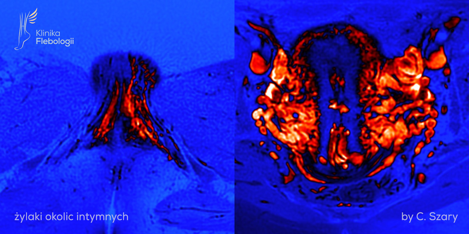 Żylaki okolic intymnych