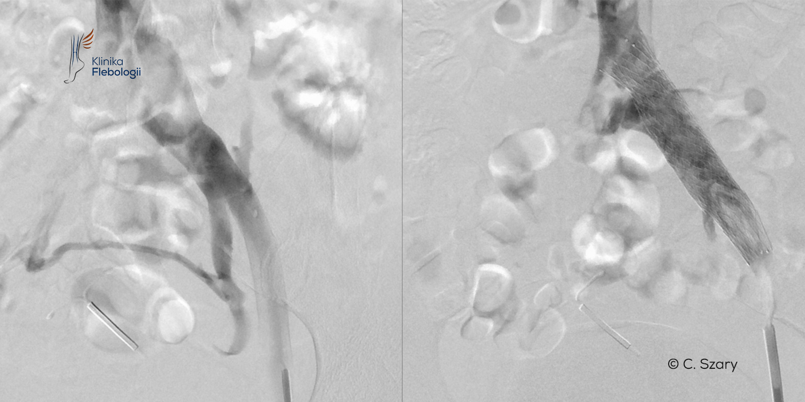 Zespół May-Thurnera stent