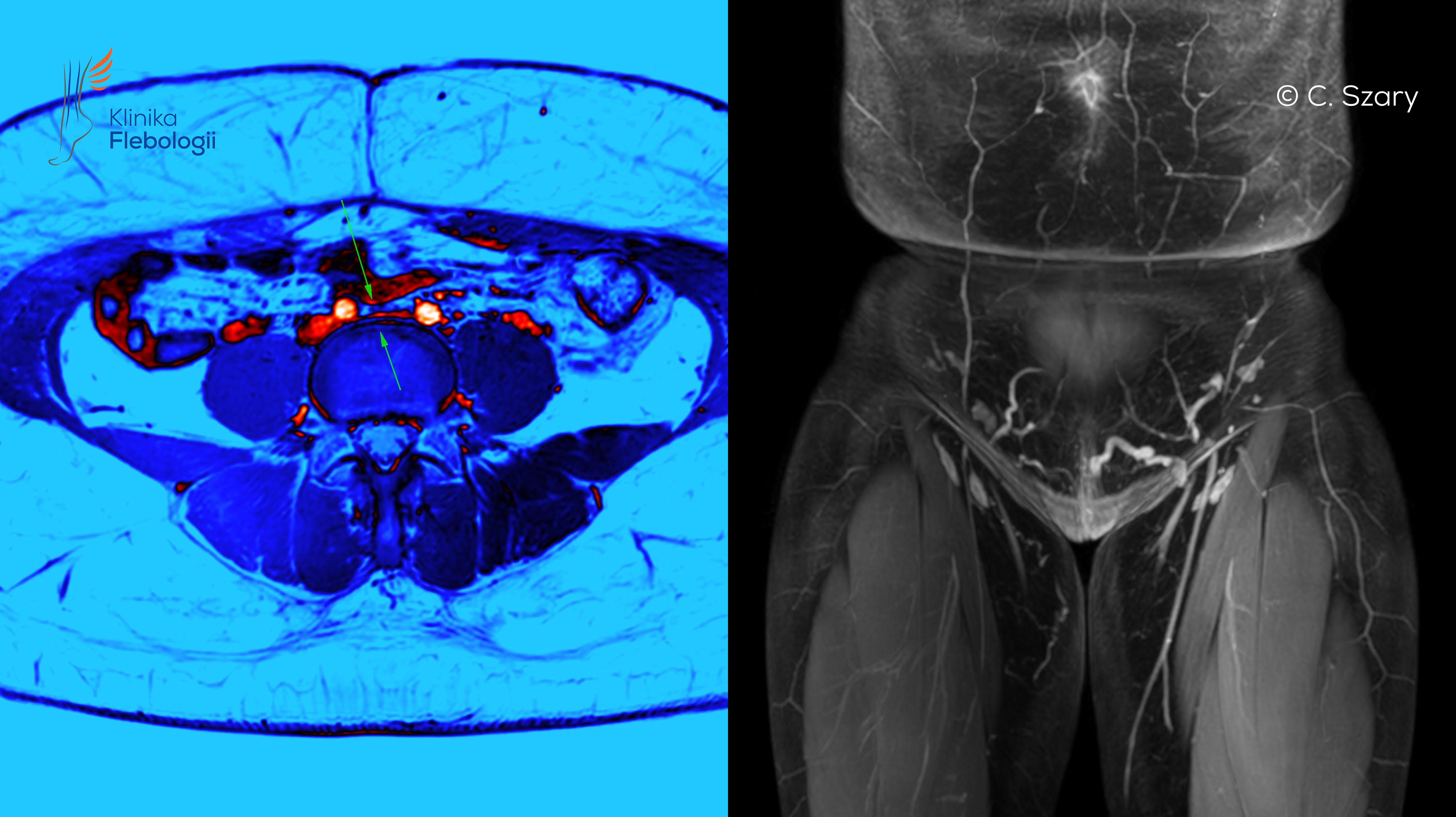 Zespół May-Thurnera