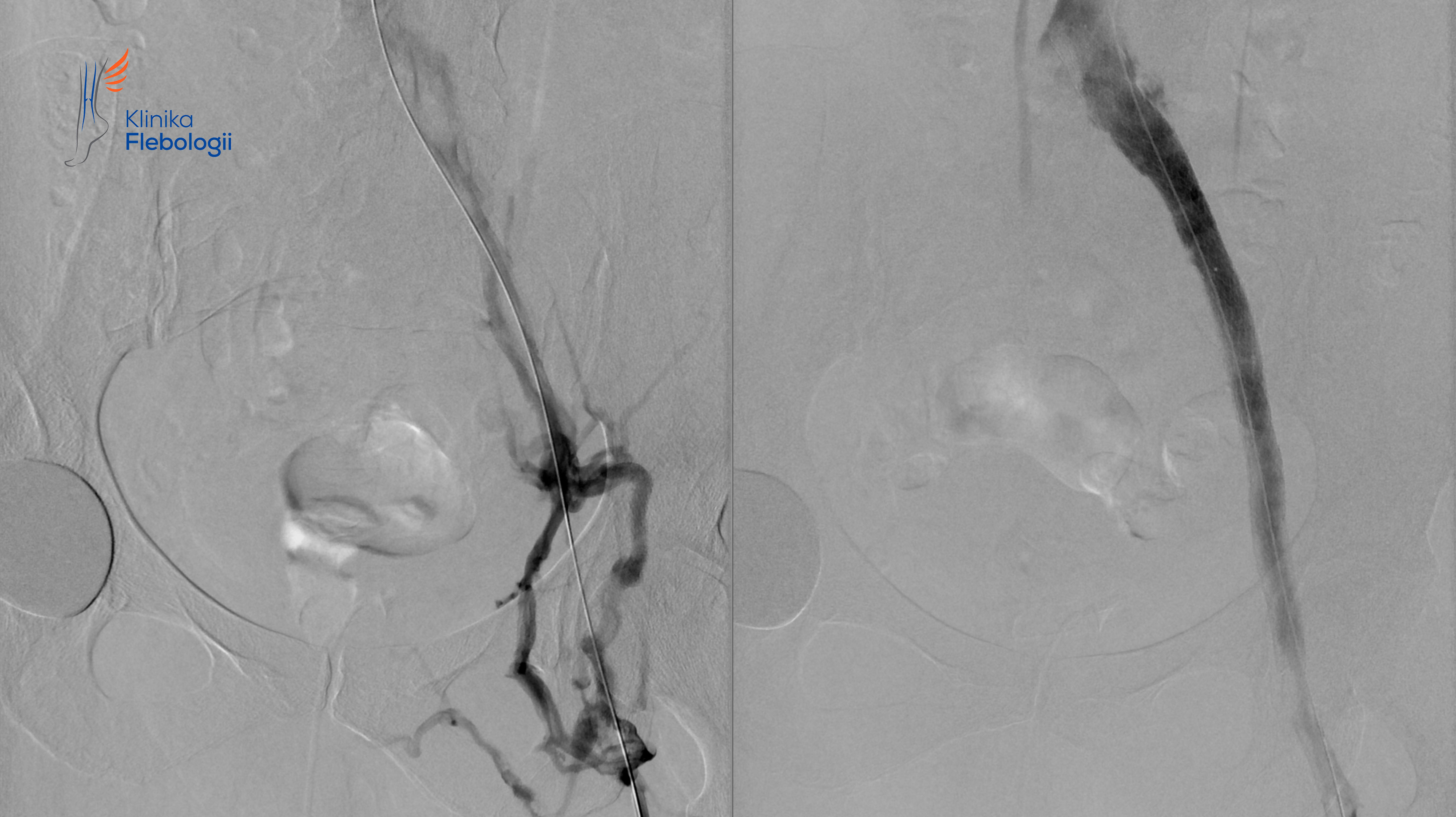 Zespół May-Thurnera. Stentowanie.