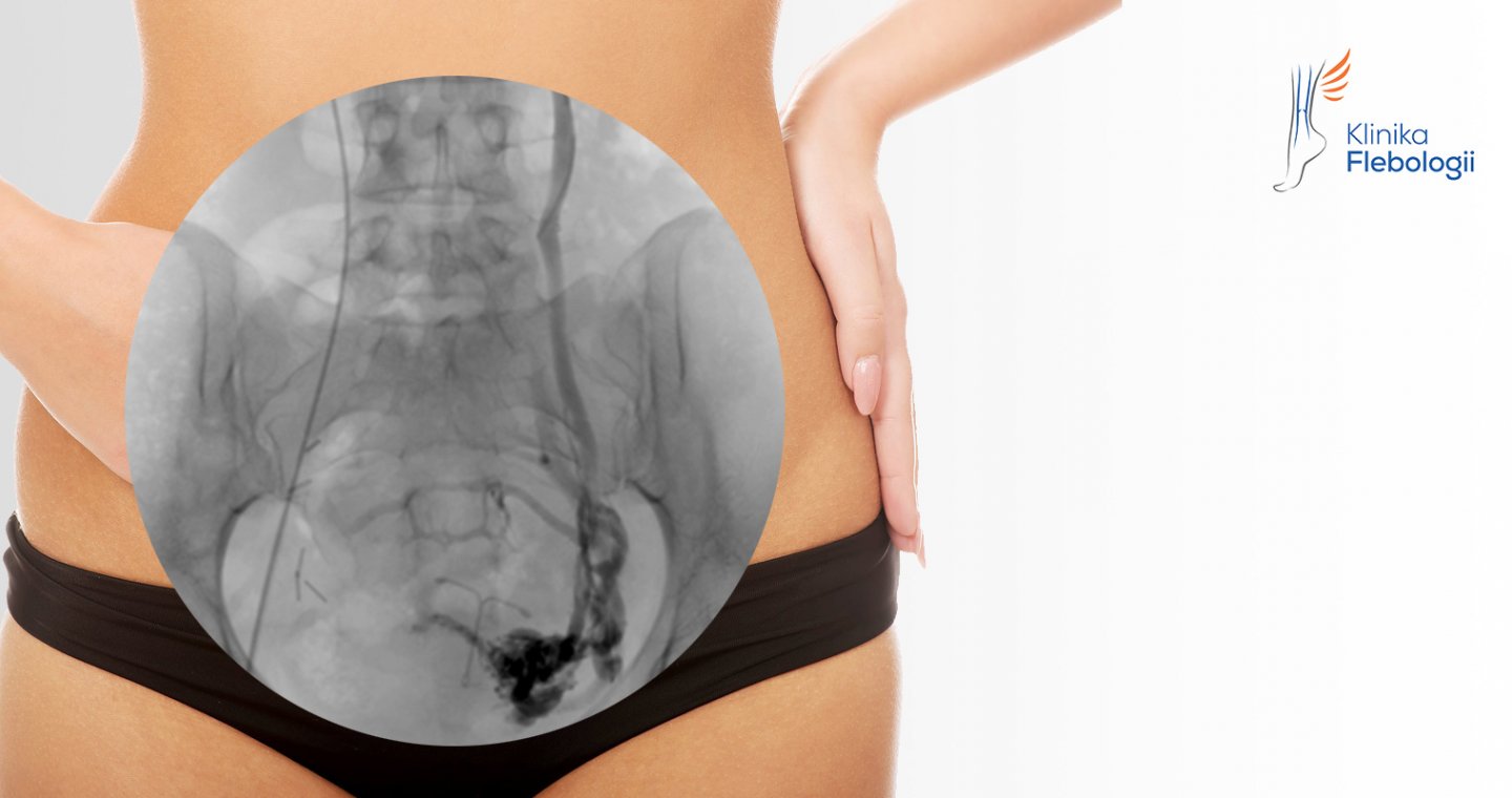 Niewydolność żyły jajnikowej