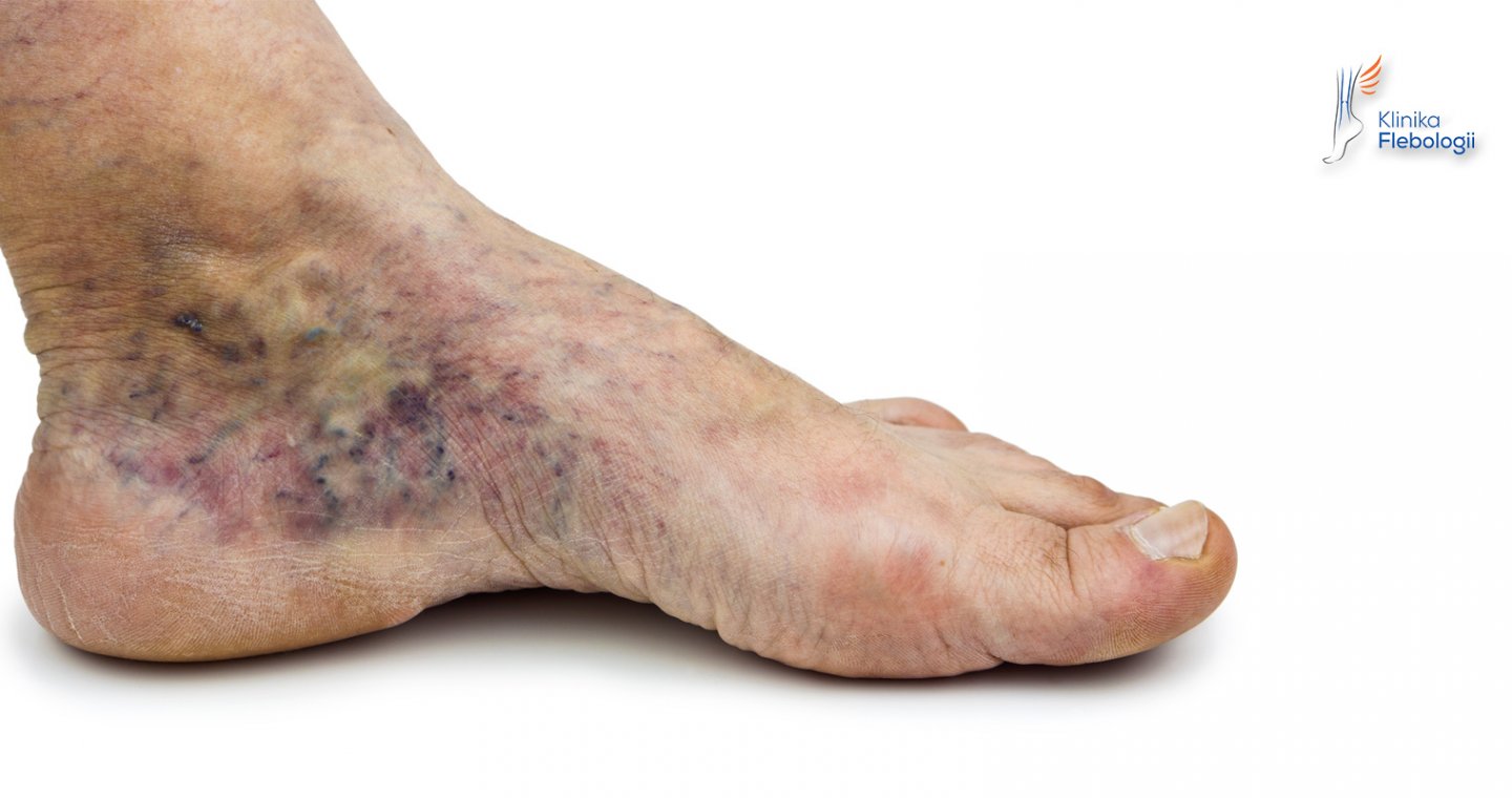 Owrzodzenia żylne - zmiany troficzne