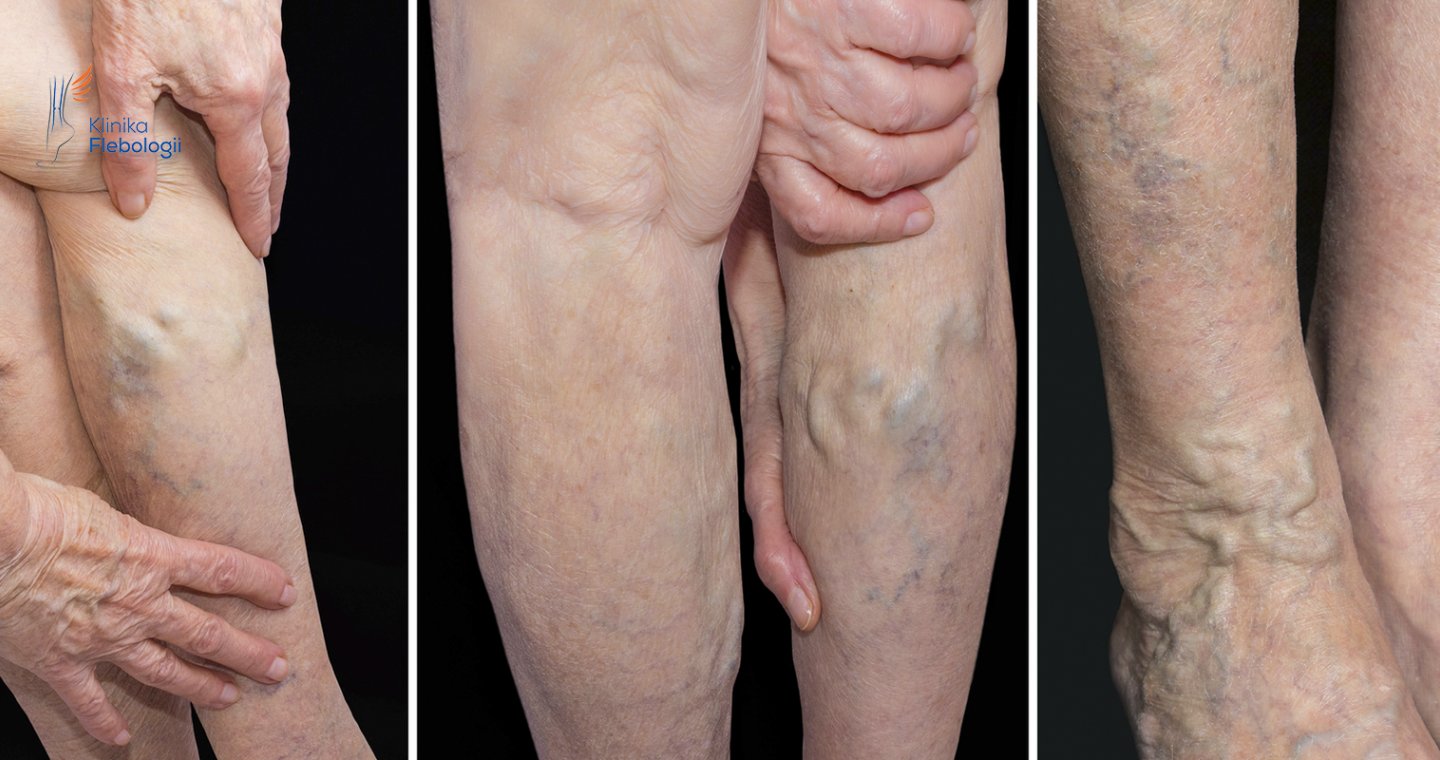 Żylaki wtórne na nogach