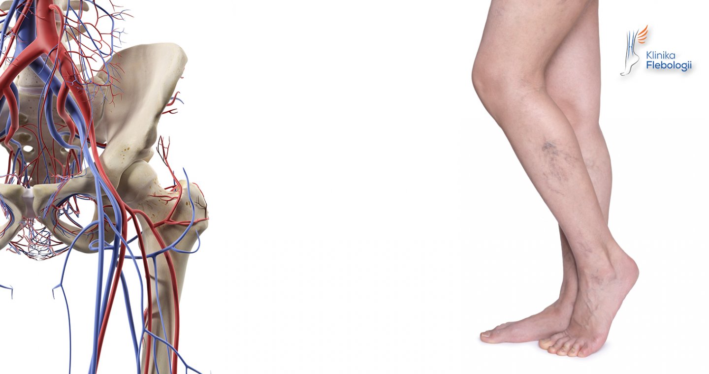 Żylne zespoły uciskowe