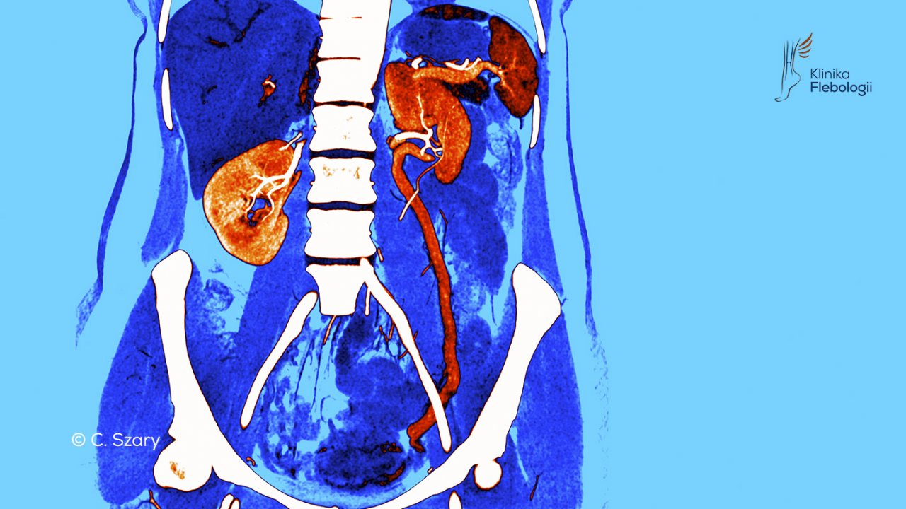 Wenografia lewej żyły jajnikowej