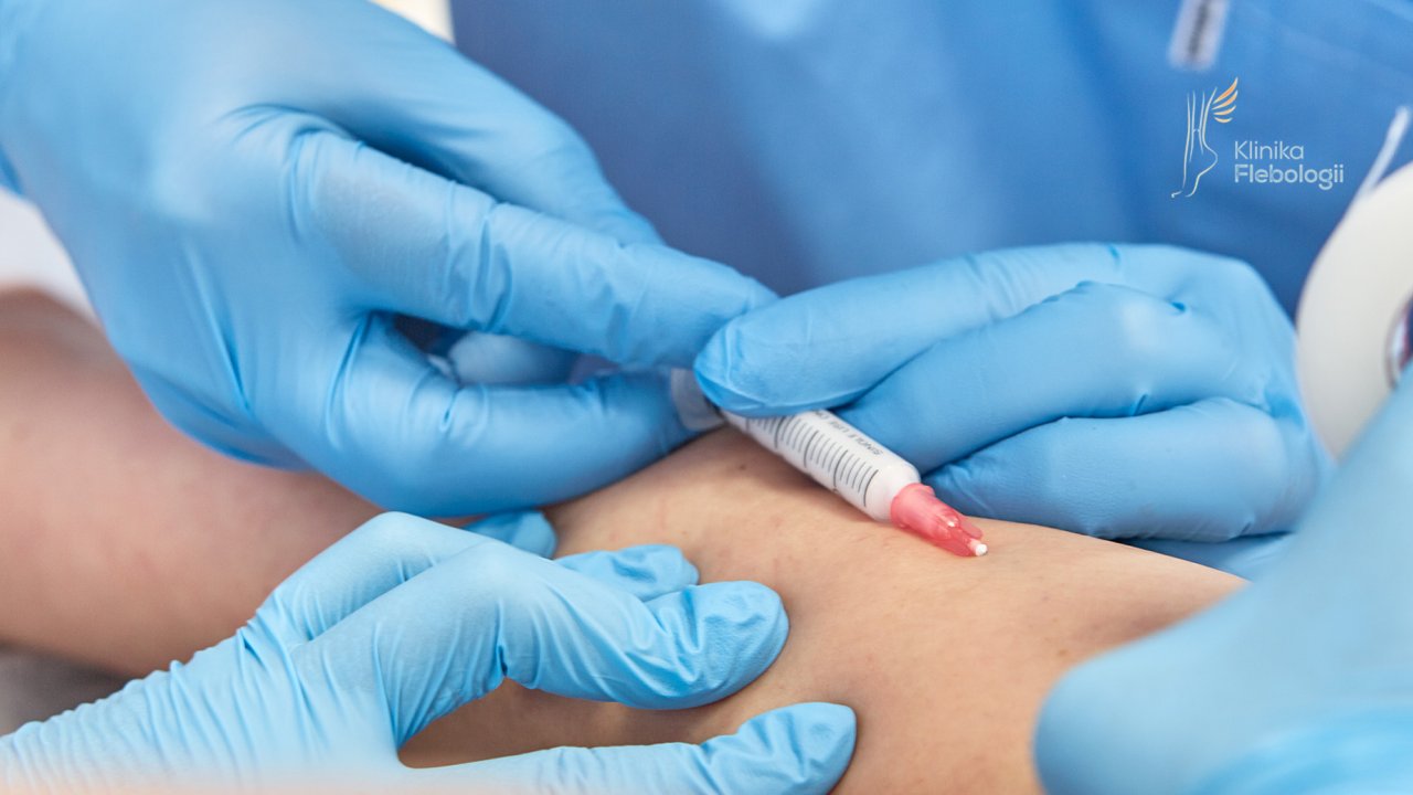 SKLEROTERAPIA PIANKOWA METODĄ INIEKCYJNĄ