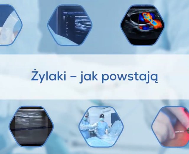 Żylaki - jak powstają?