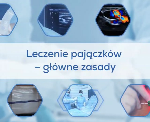 Leczenie pajączków - główne zasady