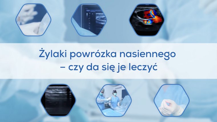 Żylaki powrózka nasiennego - czy da się je leczyć?