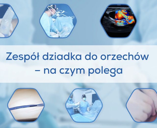 Zespół dziadka do orzechów - na czym polega?
