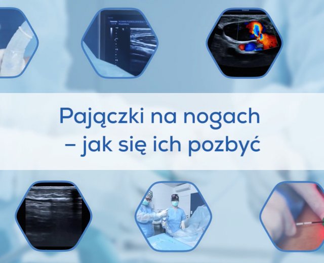 Pajączki na nogach - jak się ich pozbyć?