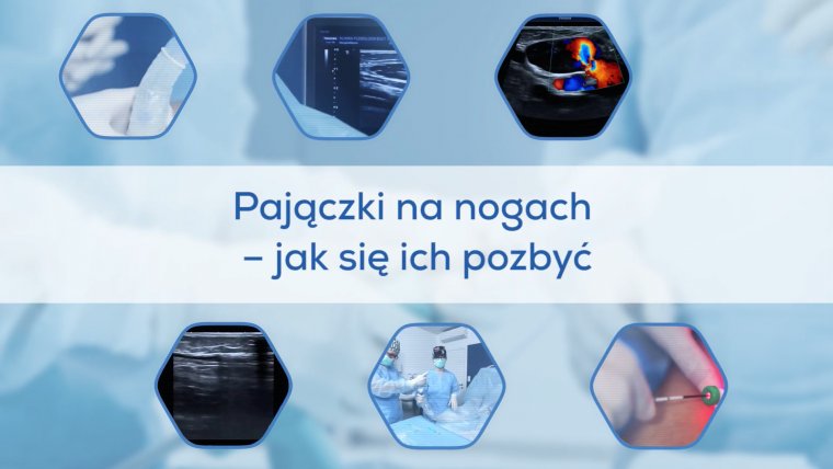 Pajączki na nogach - jak się ich pozbyć?