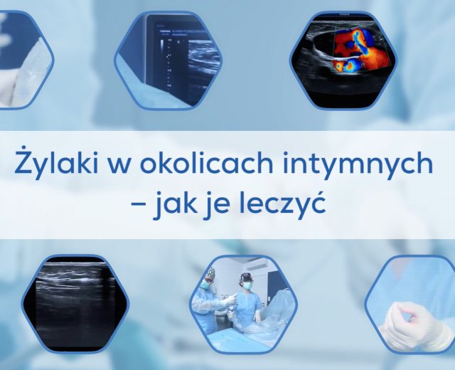 Żylaki okolic intymnych - jak je leczyć?