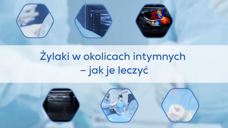 Żylaki okolic intymnych - jak je leczyć?