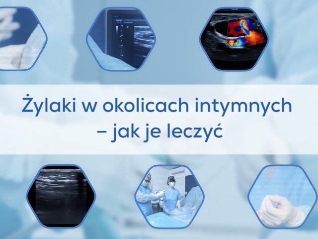 Żylaki okolic intymnych - jak je leczyć?