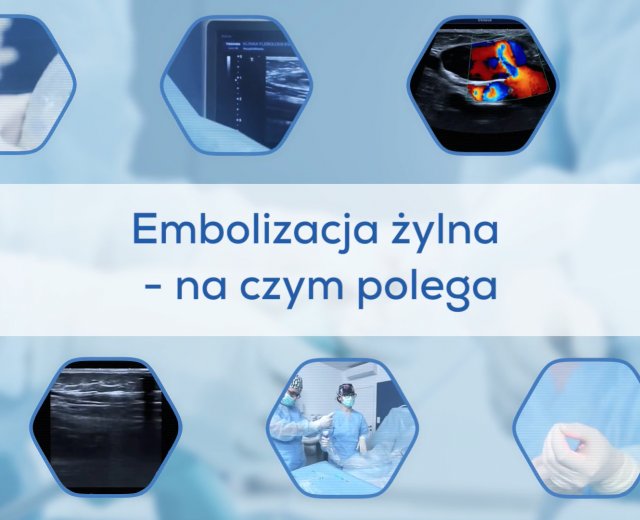 Embolizacja żylna - na czym polega?