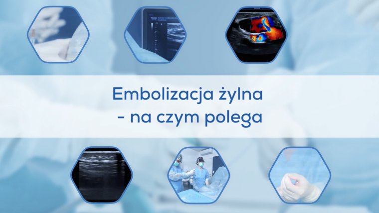 Embolizacja żylna - na czym polega?