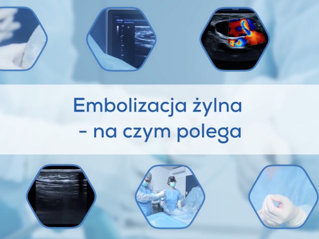 Embolizacja żylna - na czym polega?