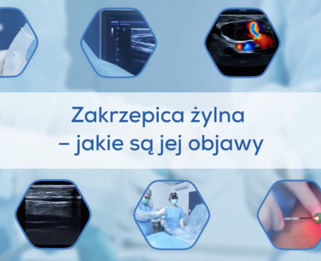 Zakrzepica żylna - jakie są jej objawy?