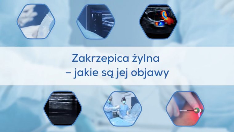 Zakrzepica żylna - jakie są jej objawy?
