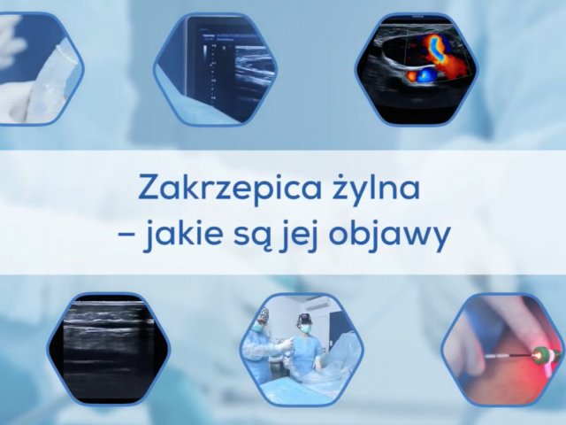 Zakrzepica żylna - jakie są jej objawy?