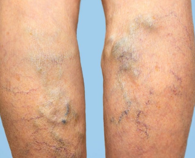 Żylaki - co to takiego?