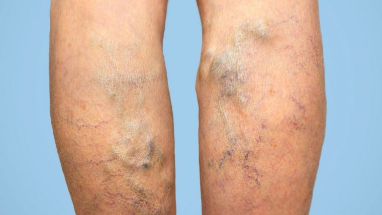 Żylaki - co to takiego?