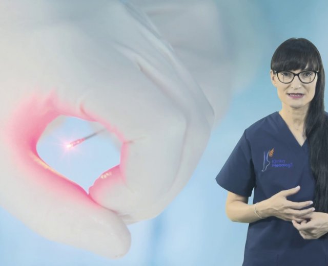 Laserowe usuwanie żylaków - jak wygląda zabieg?