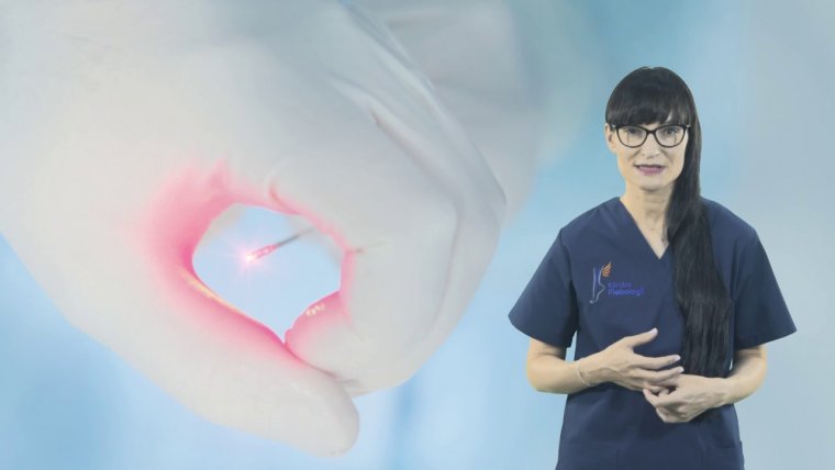 Laserowe usuwanie żylaków - jak wygląda zabieg?