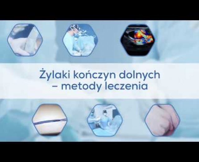 Żylaki kończyn dolnych - metody leczenia