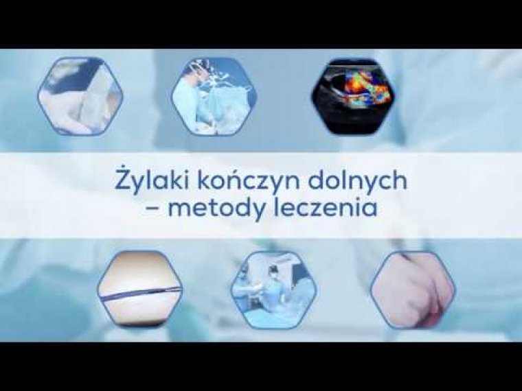 Żylaki kończyn dolnych - metody leczenia