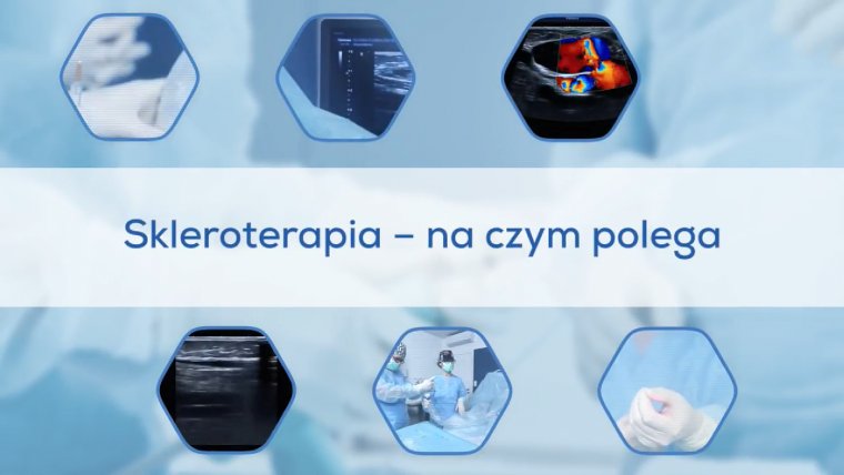 Skleroterapia - na czym polega?