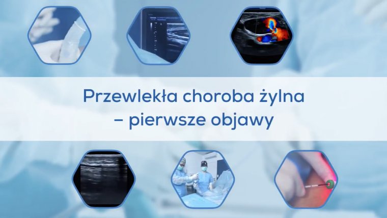 Przewlekła choroba żylna - pierwsze objawy