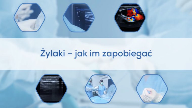 Żylaki - jak im zapobiegać?