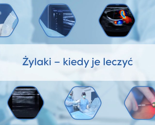 Żylaki - kiedy je leczyć?