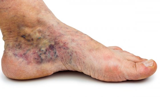 Postthrombotic syndrome