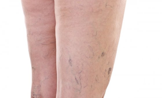 Venous insufficiency of lower limbs